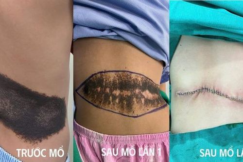Phẫu thuật thành công khối u sắc tố khổng lồ ở lưng bé 8 tuổi
