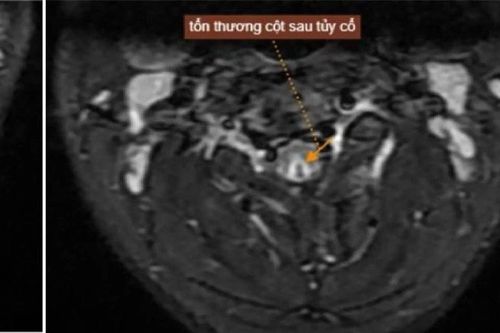 Lạm dụng bóng cười hơn 50 quả mỗi lần, nam thanh niên tổn thương tủy sống