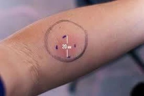 Vầng đỏ và ngứa quanh vùng mũi tiêm xét nghiệm lao là bị sao?