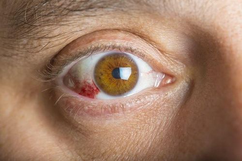 Viêm củng mạc có nguy hiểm không?