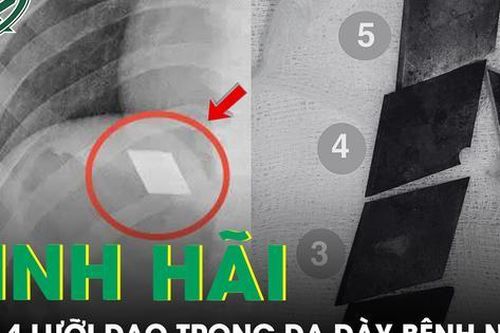 Kinh hãi nam thanh niên 26 tuổi nuốt trọn 4 lưỡi dao rọc giấy và 1 dao lam vào bụng