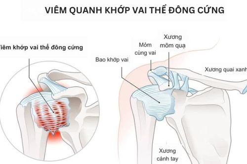 Địa chỉ vàng: Bệnh viện, phòng khám chẩn đoán tốt bệnh đau vai gáy