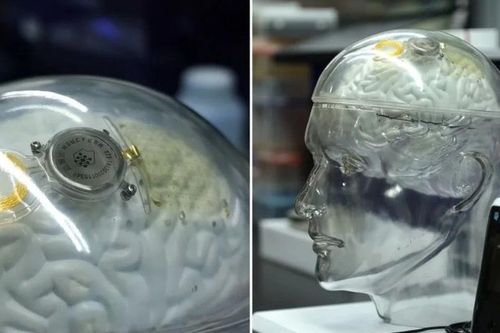Neuralink lần đầu cấy chip cho 2 bệnh nhân trong ngày
