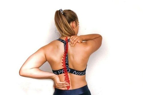 Tập gym đều mà vai lệch, lưng cong: Bạn có đang bỏ qua điều gì?