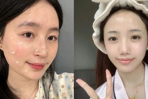 Làn da li ti mụn đã được cải thiện hoàn toàn nhờ 5 chiêu đơn giản