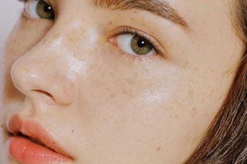 Trị nám bằng nguyên liệu tự nhiên có hiệu quả không?