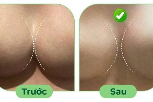 Điều trị ngực thông khe sau nâng ngực
