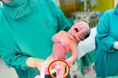 Dây rốn xoắn nhiều vòng, thai nhi thoát khỏi cửa tử nhờ bất thường hiếm gặp