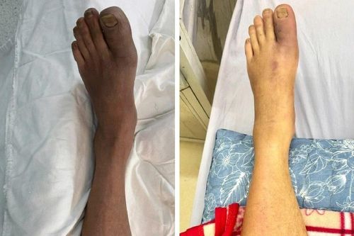 Cấp cứu trong đêm vì chân lạnh đau do tắc mạch chi