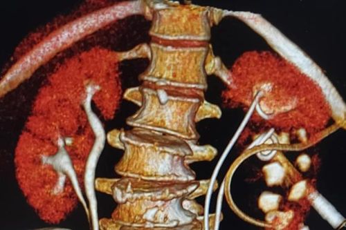 Từ TPHCM ra Hà Nội khám bệnh, người phụ nữ phát hiện có 4 quả thận