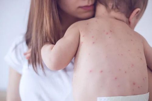 Cảnh báo các dịch bệnh nổi lên trong mùa hè 2025