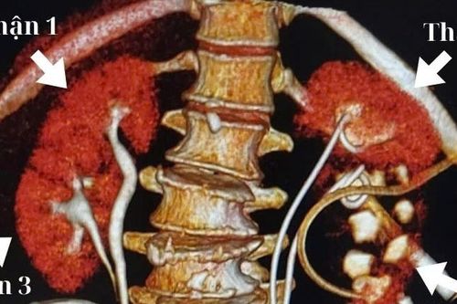 Đau lưng kéo dài, người phụ nữ đi khám mới biết đang sống với 4 quả thận