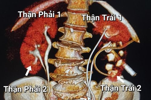 Người phụ nữ phát hiện có 4 quả thận