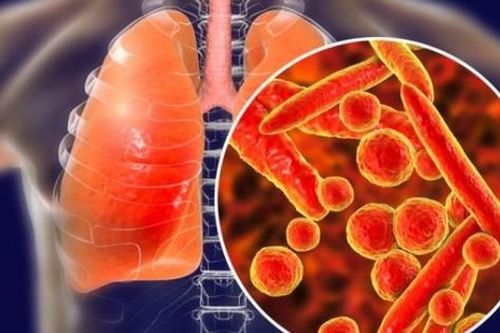 Những dấu hiệu cảnh báo sớm bệnh lao phổi bạn không nên bỏ qua