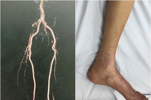 Thầy giáo suýt bị cưa 2 chân do tắc mạch chi từ lâu nhưng không có điều kiện đi chữa