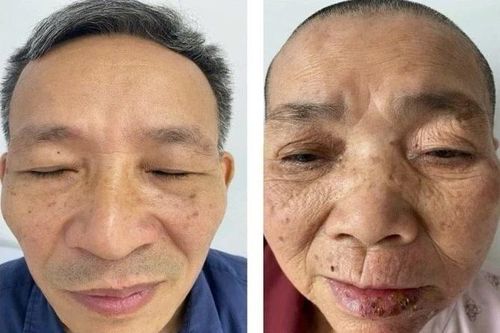 Cẩn thận virus Zona tái hoạt ở dây thần kinh mặt gây liệt
