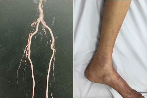 Cụ ông 84 tuổi suýt phải cắt cụt 2 chân do tắc mạch chi nặng nề