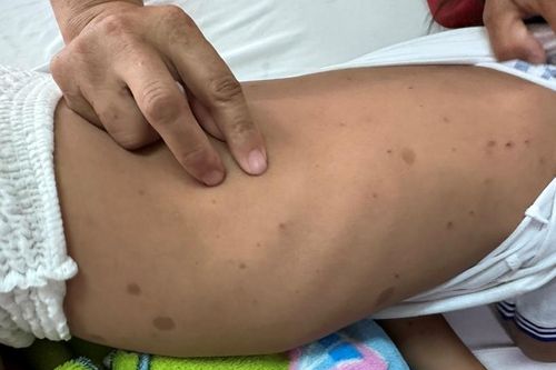 Hai cháu bé bị ong đốt hàng trăm vết trên cơ thể