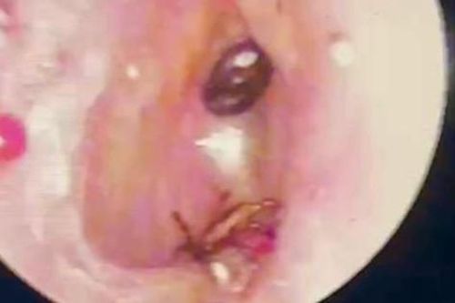 Nội soi tai bé trai 9 tuổi, bác sĩ phát hiện điều đáng sợ