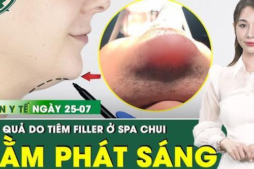 Bản tin Y tế 25/7: Tiêm filler ở spa 'chui', cằm chàng trai 'phát sáng' phải về Việt Nam cấp cứu