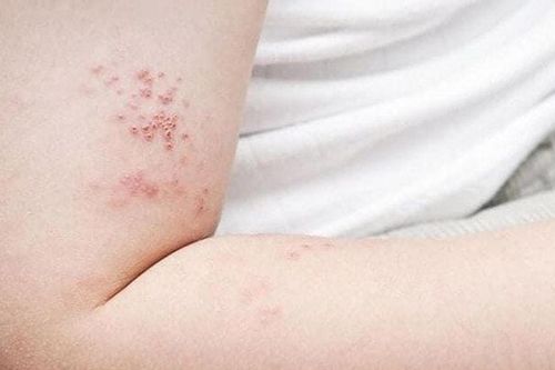 Liệt mặt do zona: Hiểm họa có thể phòng ngừa