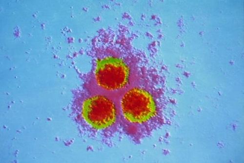 Một loại virus 'ngủ quên' bỗng tái phát gây liệt mặt