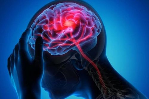 Kiểu đau đầu sét đánh nguy cơ tử vong cao 40-50%