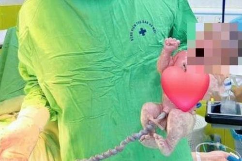 Thai nhi thoát khỏi cửa tử nhờ dây rốn dài khoảng 1 mét, hiếm gặp
