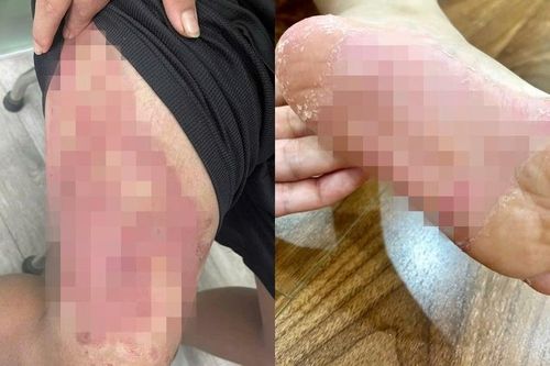Sau bão số 3, bệnh da liễu tăng vọt