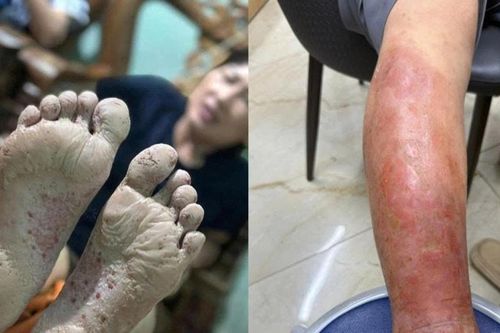 Bác sĩ cảnh báo bệnh da liễu sau mưa lũ: Vết ngứa nhỏ có thể thành ổ nhiễm trùng
