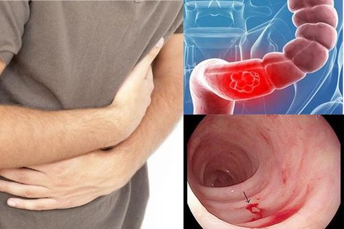 Phát hiện mắc ung thư sau 3 tháng rối loạn tiêu hóa
