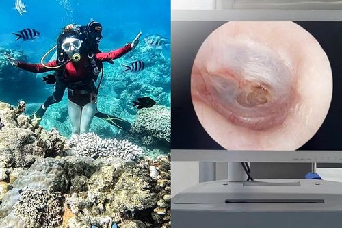 Cô gái ở TP.HCM bị thủng màng nhĩ sau khi lặn biển, tổn thương do thay đổi áp suất