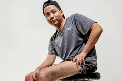 Khoa Pug chi 3 tỷ kéo chân lần 2: Bác sĩ nói gì?