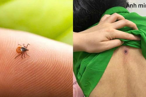 Sốt cao, rét run, người đàn ông 46 tuổi nguy kịch từ vết mò đốt