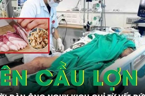 Chế biến tóp mỡ, người đàn ông bị nhiễm liên cầu lợn từ vết cắt nhỏ trên tay