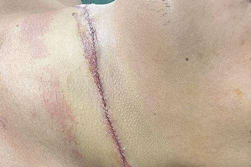 Nam thanh niên bị dây thép cứa ngang cổ khi đang đi xe máy