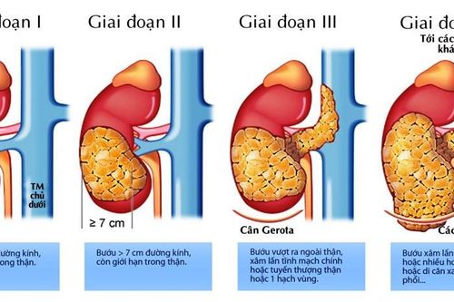 Hút thuốc lá làm tăng 50% nguy cơ mắc ung thư thận