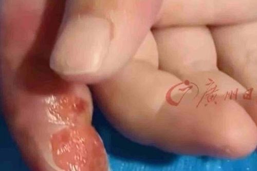 Sơ suất khi cai mút tay, bé 11 tháng suýt cụt ngón vì mẹ làm theo mẹo dân gian
