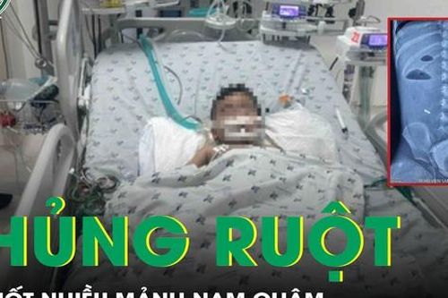 Bé trai 3 tuổi bị thủng ruột do nuốt nhiều mảnh nam châm