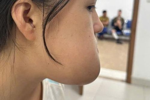 Phẫu thuật loại bỏ khối u, lấy lại thẩm mỹ khuôn mặt cho cô gái 16 tuổi