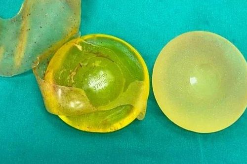 Silicon tràn ra khoang ngực sau 22 năm 'dao kéo'
