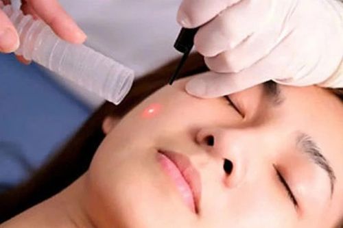 Hướng dẫn tẩy nốt ruồi bằng laser an toàn, hiệu quả cao
