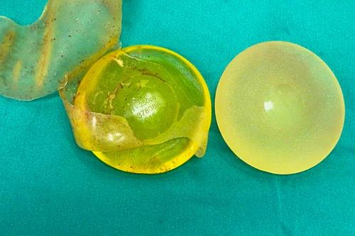Việt kiều về nước tình cờ phát hiện rách túi ngực sau 20 năm phẫu thuật thẩm mỹ