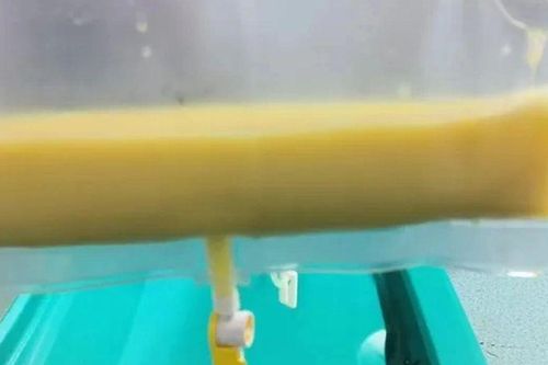 Máu trắng đục như sữa, nam bệnh nhân trẻ suýt mất mạng vì viêm tụy cấp