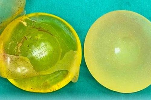 Đi khám sức khỏe định kỳ, người phụ nữ 50 tuổi phát hiện vỡ túi ngực silicon mà không biết