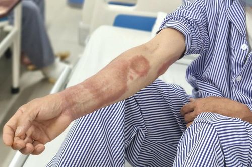 Vết loang kỳ lạ trên da hé lộ căn bệnh tưởng đã bị quên lãng