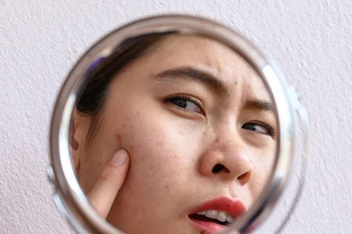 Hậu quả không thể cứu vãn từ thói quen nặn mụn