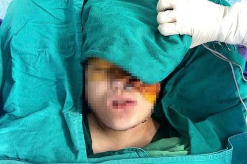 Phẫu thuật loại bỏ thành công khối u 'khủng' trên mặt cho bé gái 16 tuổi