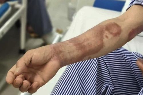 Ba năm mang 'chấm lạ', hai cha con đi khám mới biết mắc bệnh phong