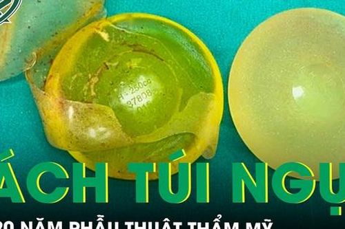Rách túi ngực sau 20 năm phẫu thuật thẩm mỹ